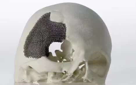 顱骨3D打印技術(shù)是什么？